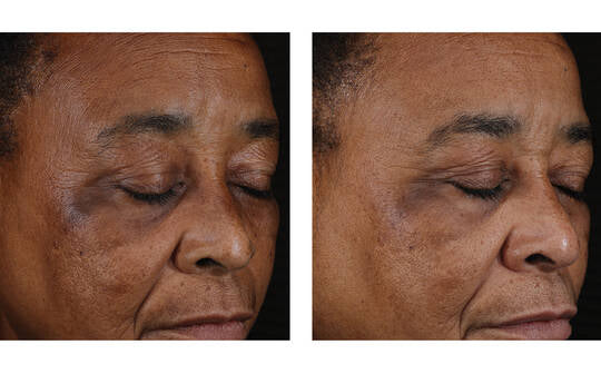 SkinBetter MYSTRO