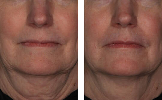 SkinBetter Interfuse Treatment Face&Neck